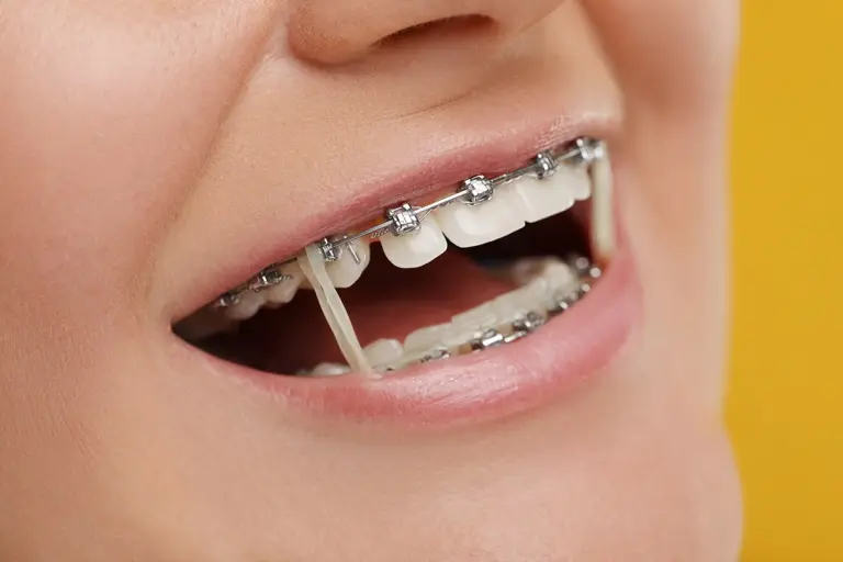 Braces with elastic bands